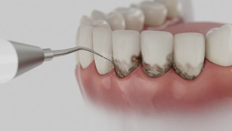 Reliable Dental Implants contractor in Blue Ridge, GA by Smile Center Dentistry